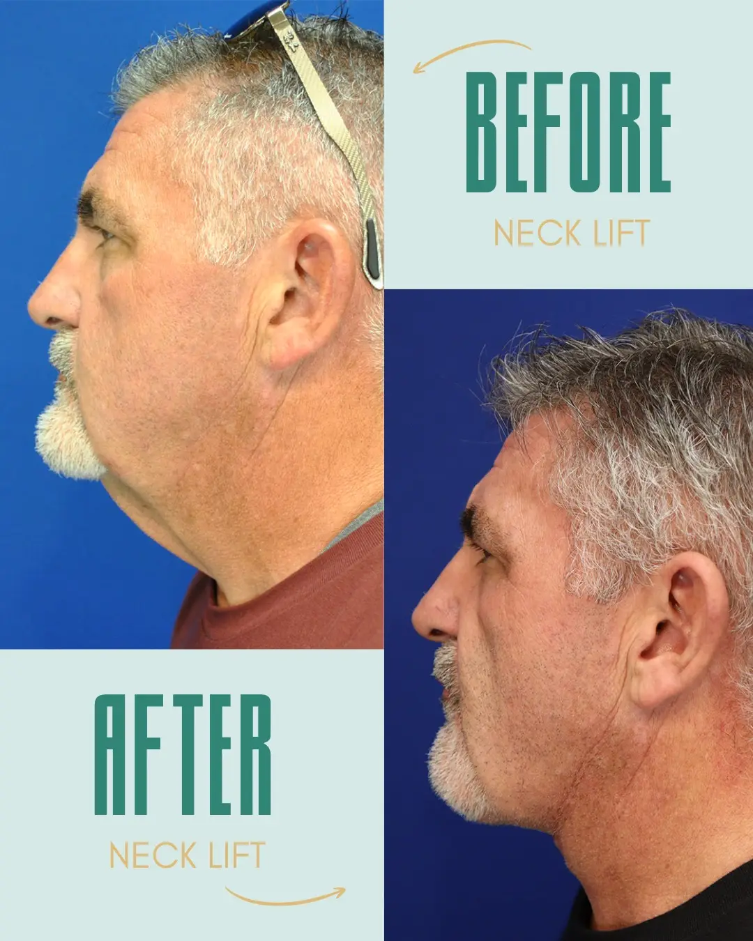 Before and after a direct neck lift: side profile of a male patient. Before, on the left, loose skin and fullness under the chin blur the jawline. After, on the right, the jawline is more defined and the neckline smoother.