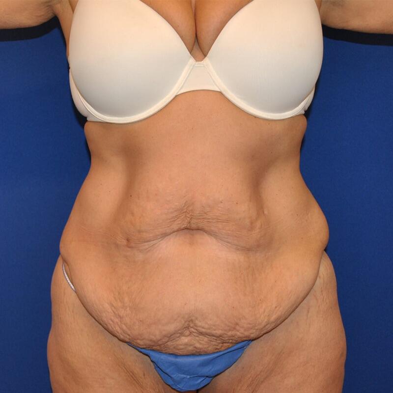 Tummy Tuck Patient 01 — Before (1 of 6)