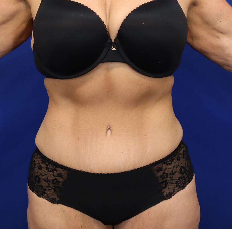 Tummy Tuck Patient 01 — After (2 of 6)