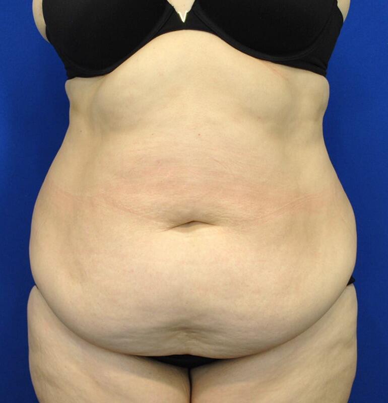 Tummy Tuck Patient 02 — Before (1 of 6)