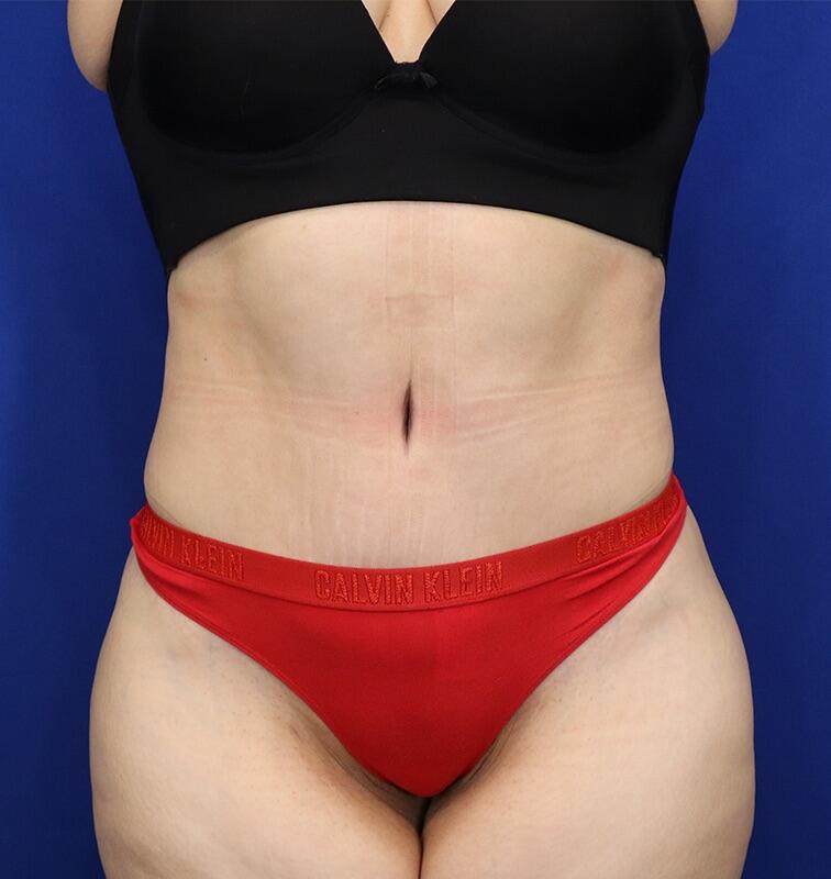 Tummy Tuck Patient 02 — After (2 of 6)