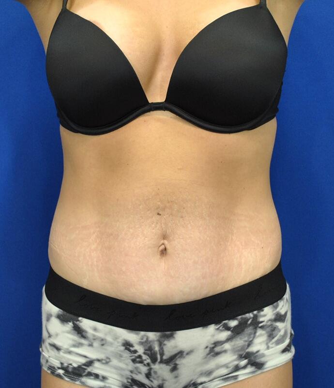 Tummy Tuck Patient 03 — Before (1 of 6)