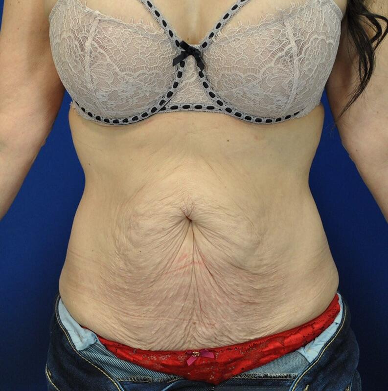 Tummy Tuck Patient 04 — Before (1 of 6)