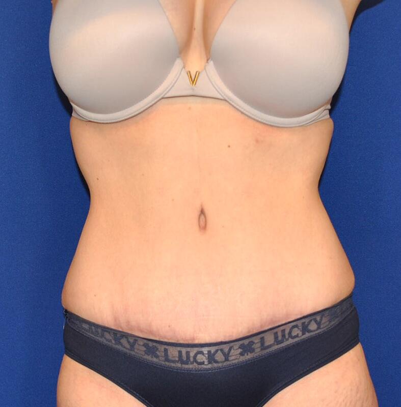 Tummy Tuck Patient 04 — After (2 of 6)