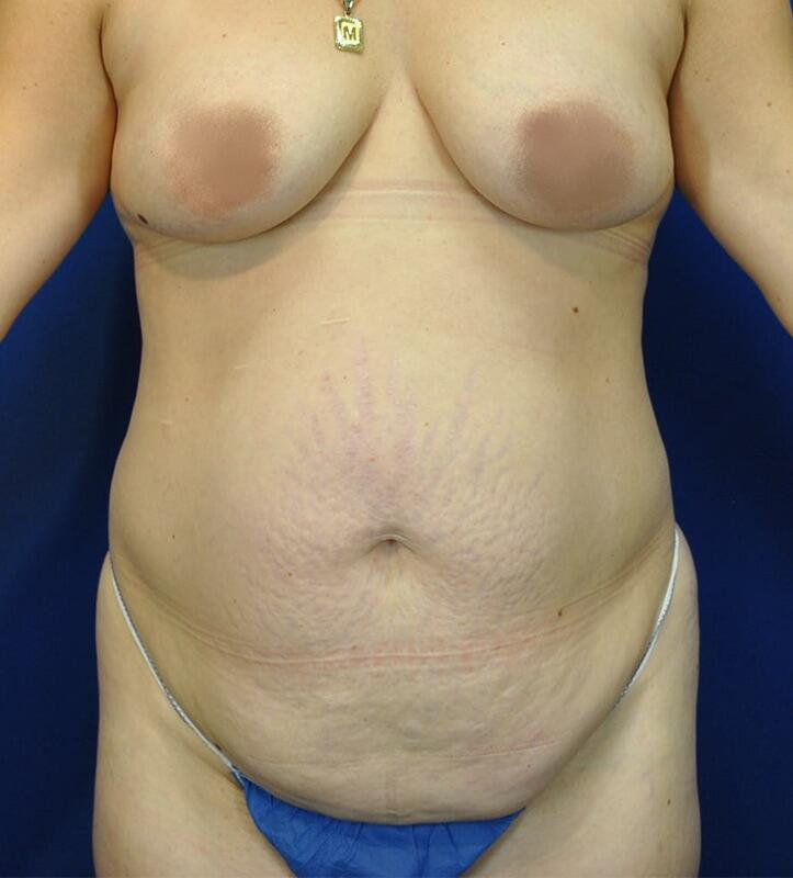 Tummy Tuck Patient 05 — Before (1 of 6)