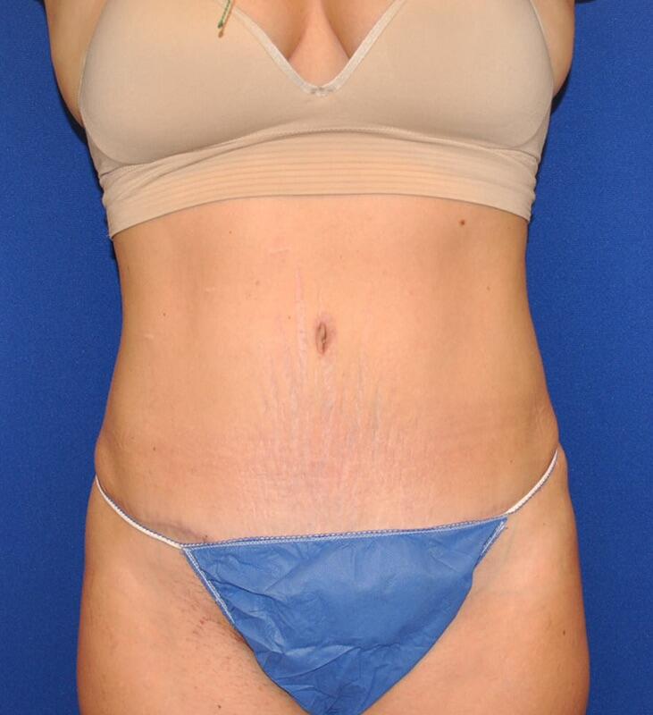 Tummy Tuck Patient 05 — After (2 of 6)