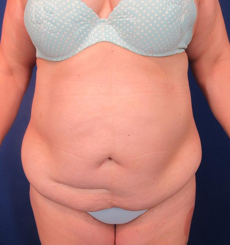 Tummy Tuck Patient 06 — Before (1 of 6)