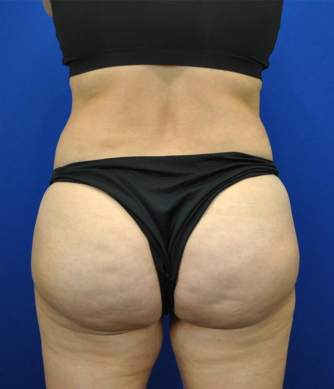 Brazilian Butt Lift Patient 01 — After (4 of 8)