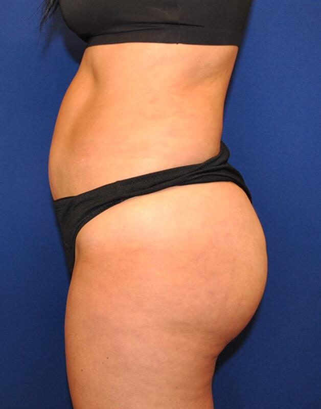 Brazilian Butt Lift Patient 01 — After (6 of 8)