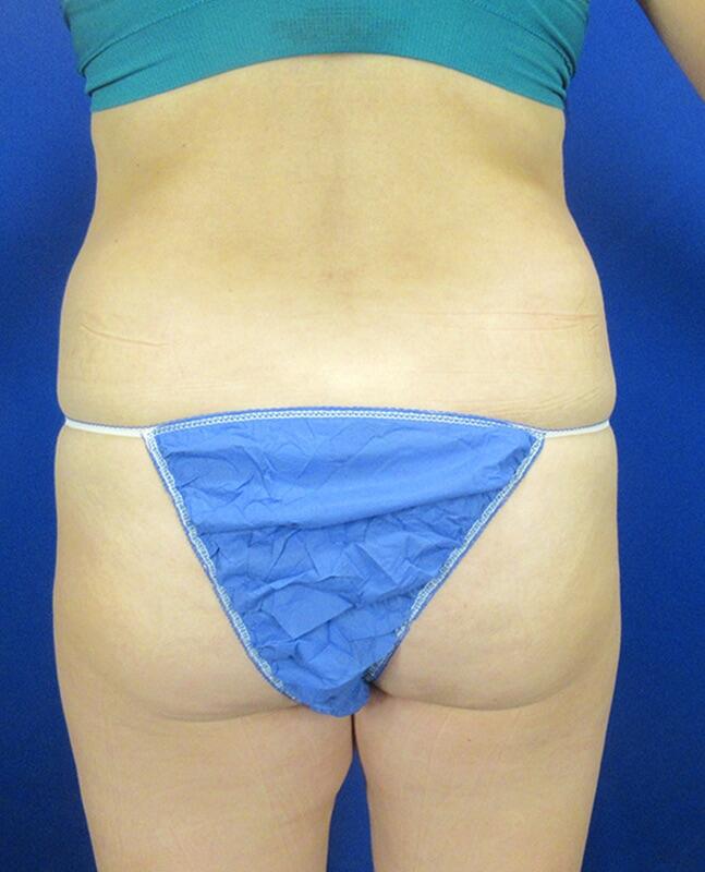 Brazilian Butt Lift Patient 01 — Before (7 of 8)