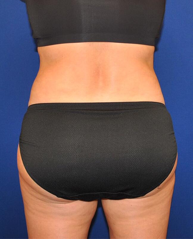Brazilian Butt Lift Patient 01 — After (8 of 8)