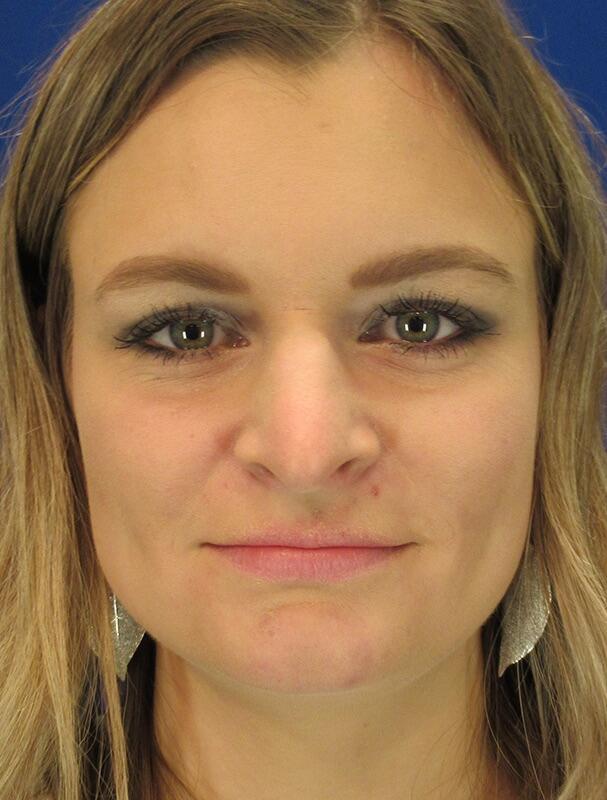 Rhinoplasty Patient 01 — Before (1 of 6)