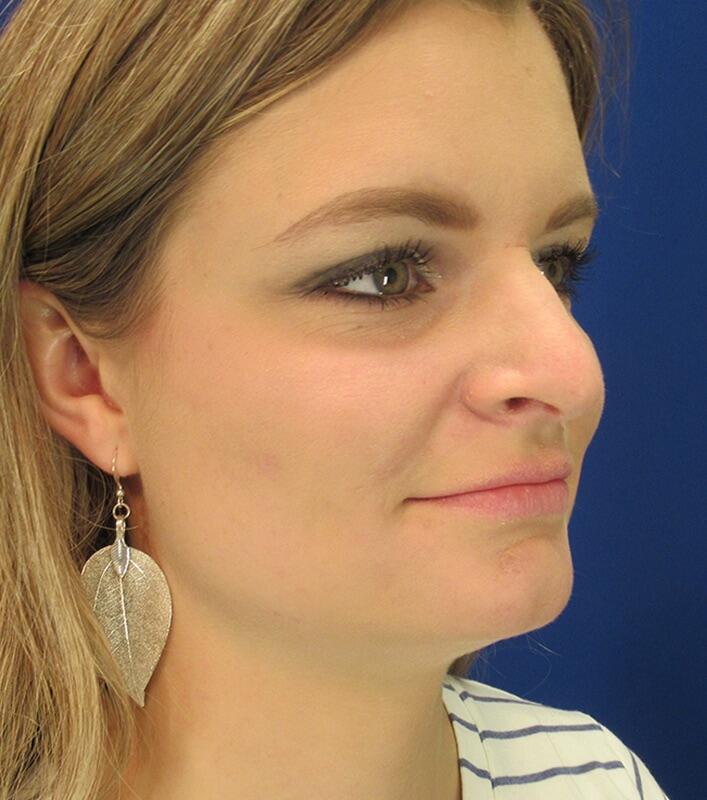 Rhinoplasty Patient 01 — Before (3 of 6)