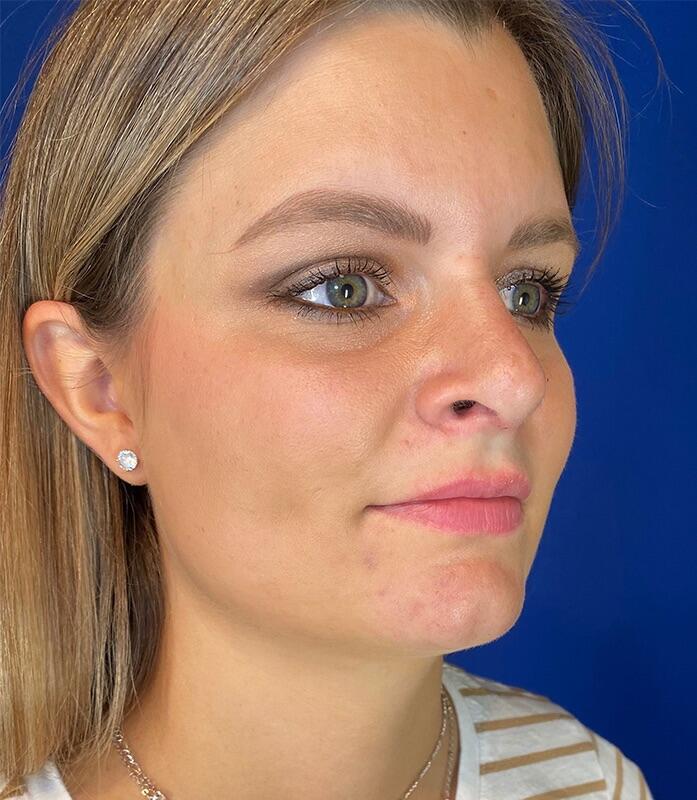 Rhinoplasty Patient 01 — After (4 of 6)