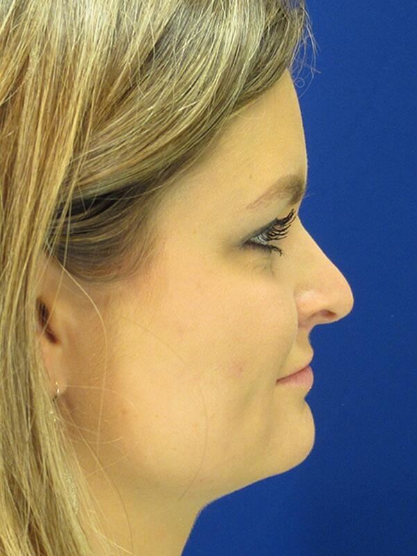 Rhinoplasty Patient 01 — Before (5 of 6)