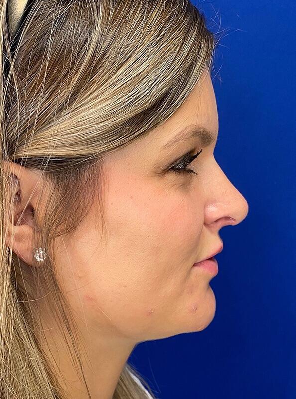 Rhinoplasty Patient 01 — After (6 of 6)
